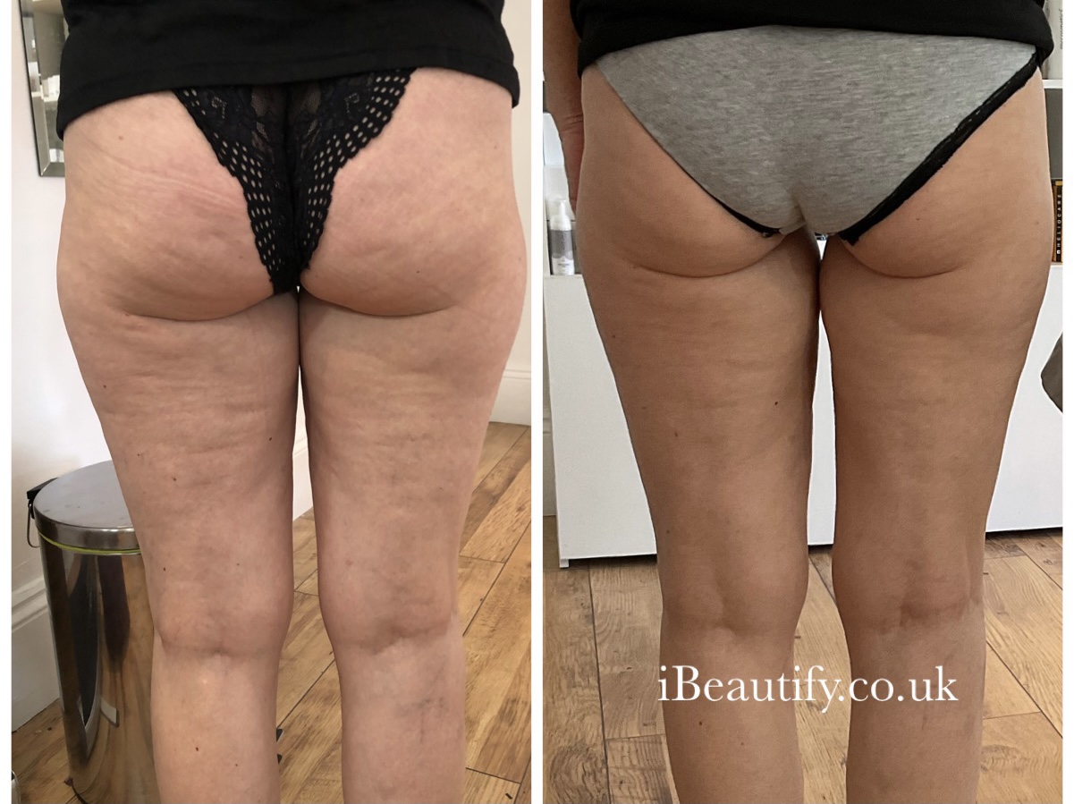 HIFU Body Contouring - before and after at iBeautify, Tunbridge Wells