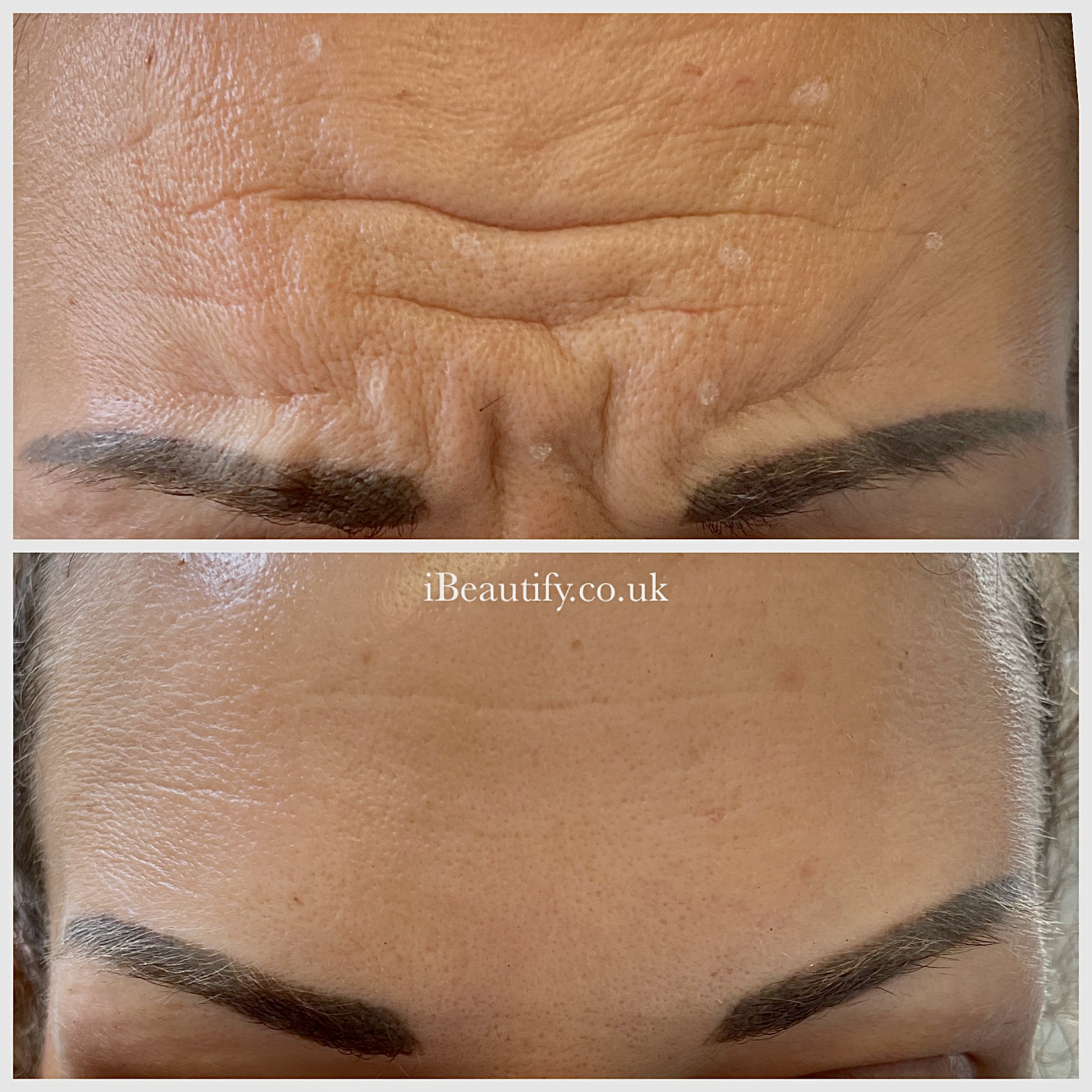 Anti-Wrinkle Treatment - before and after at iBeautify, Tunbridge Wells