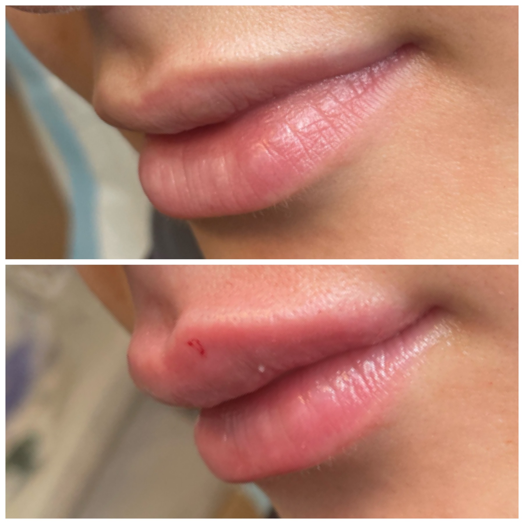 Dermal Lip Filler - before and after at iBeautify, Tunbridge Wells