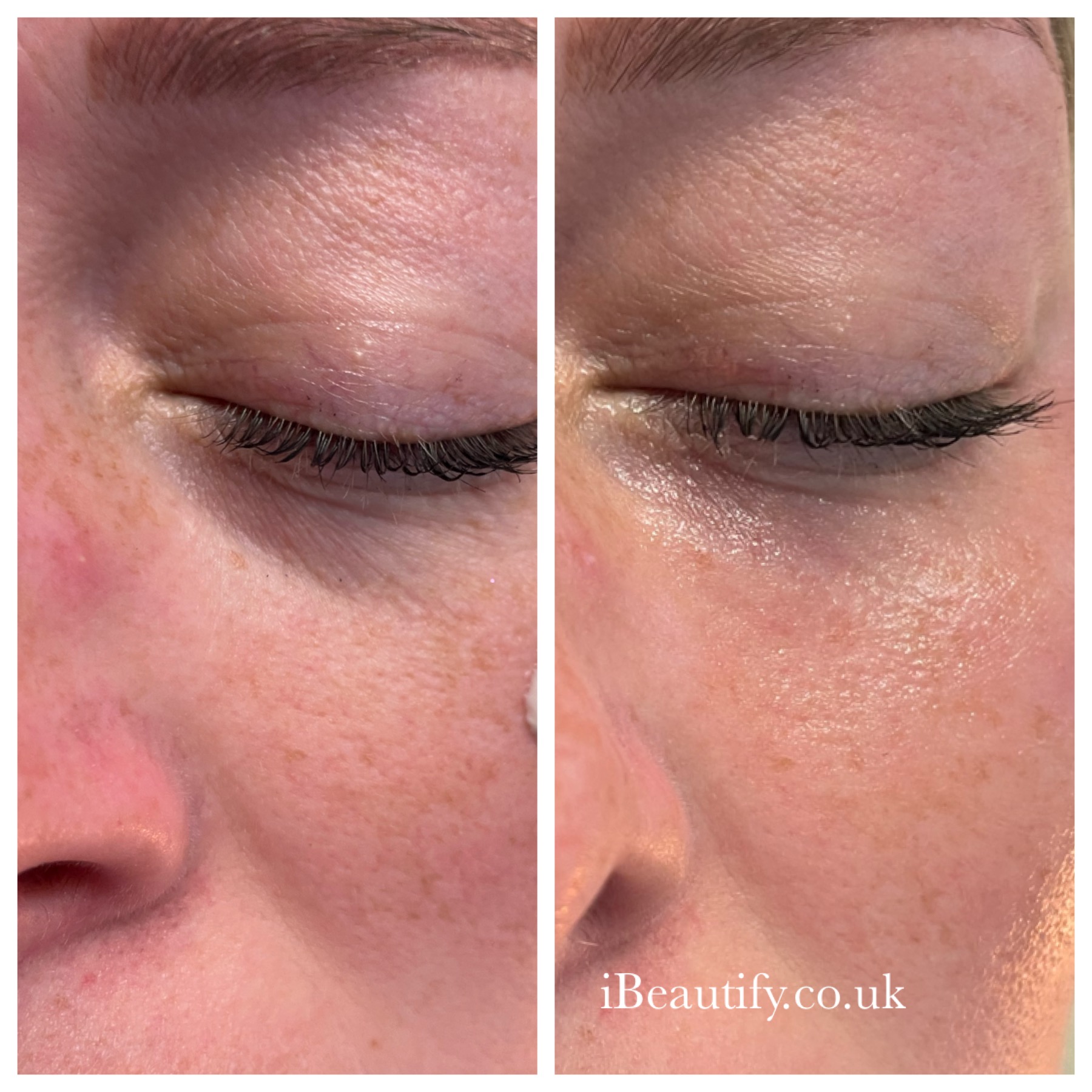 Periorbital Rejuvenation - before and after at iBeautify, Tunbridge Wells