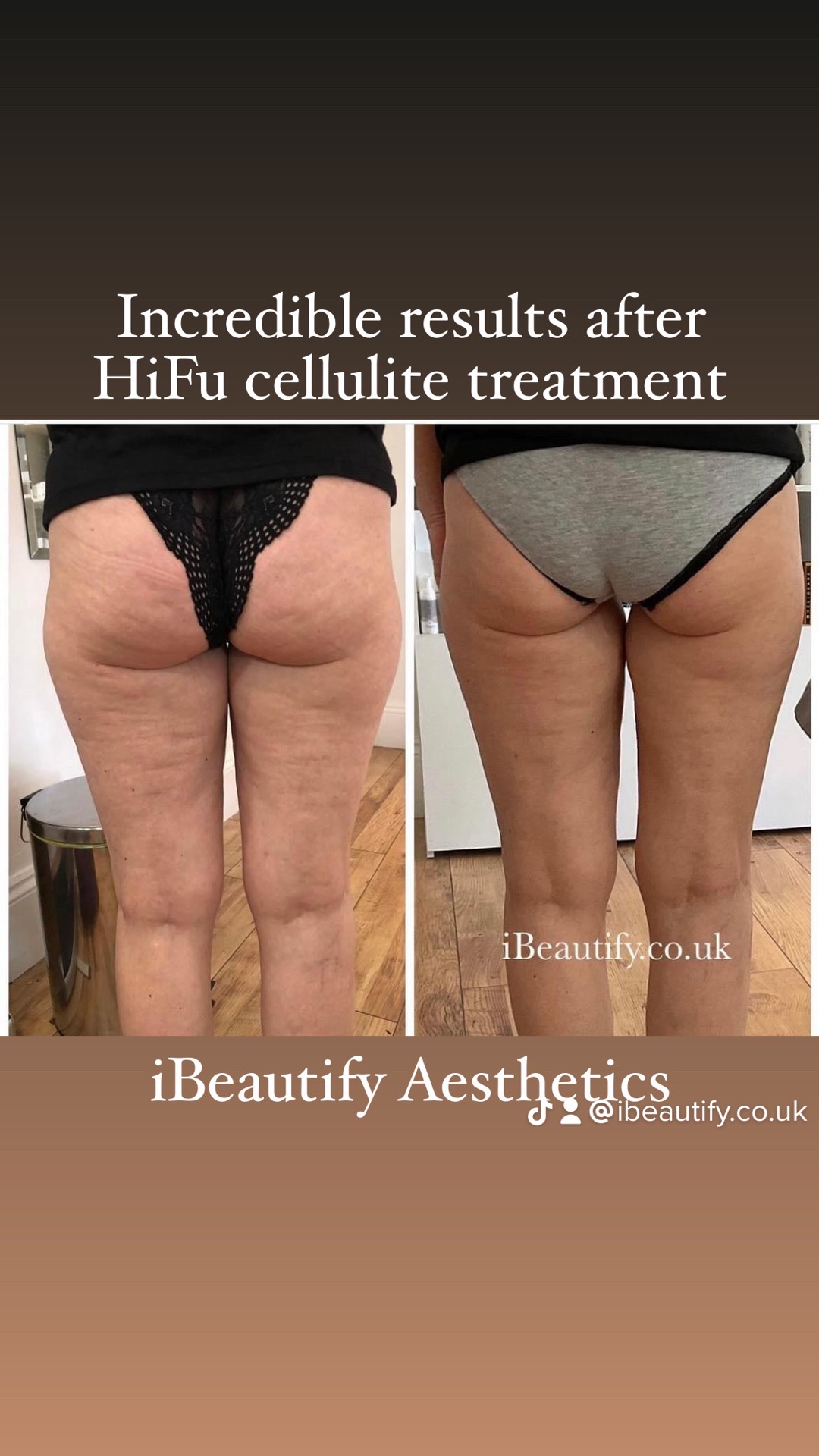 HIFU Cellulite before and after - iBeautify Tunbridge Wells