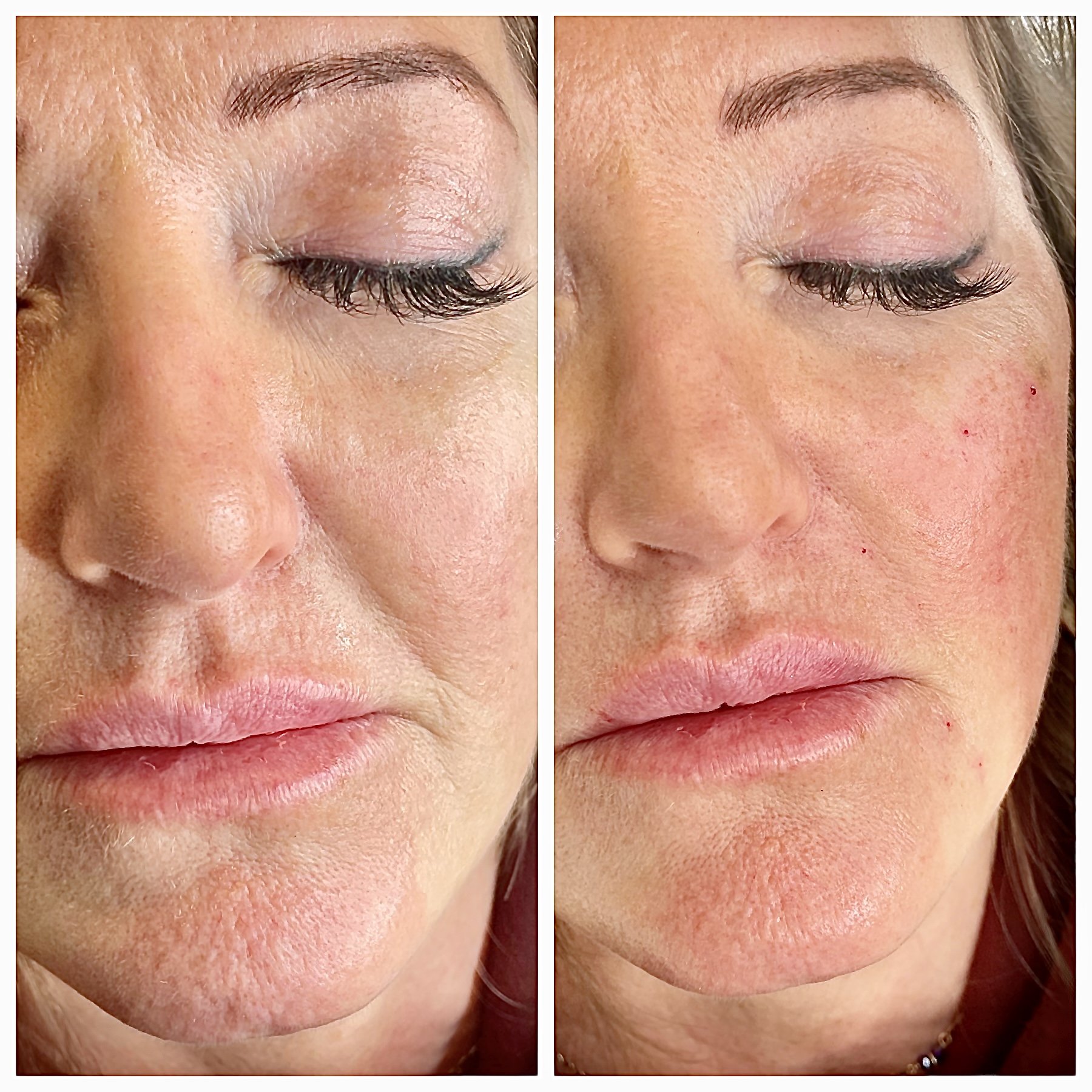 Skin Texture Improvement - before and after at iBeautify, Tunbridge Wells
